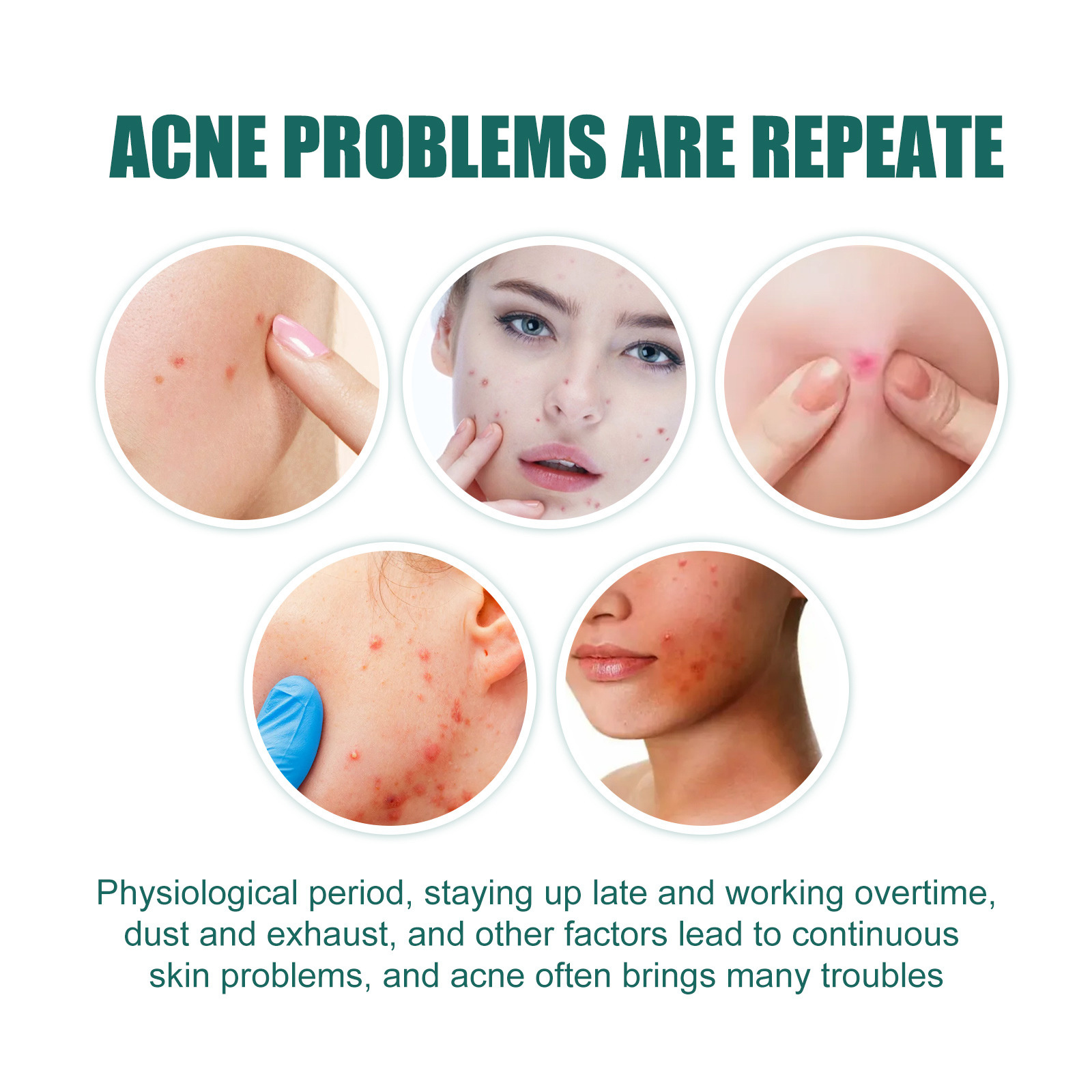 EELHOE Love Acne Patch Gentle Cleansing Acne Patch Fades Facial Acne Marks And Spots Facial Cleansing Care - Image 4